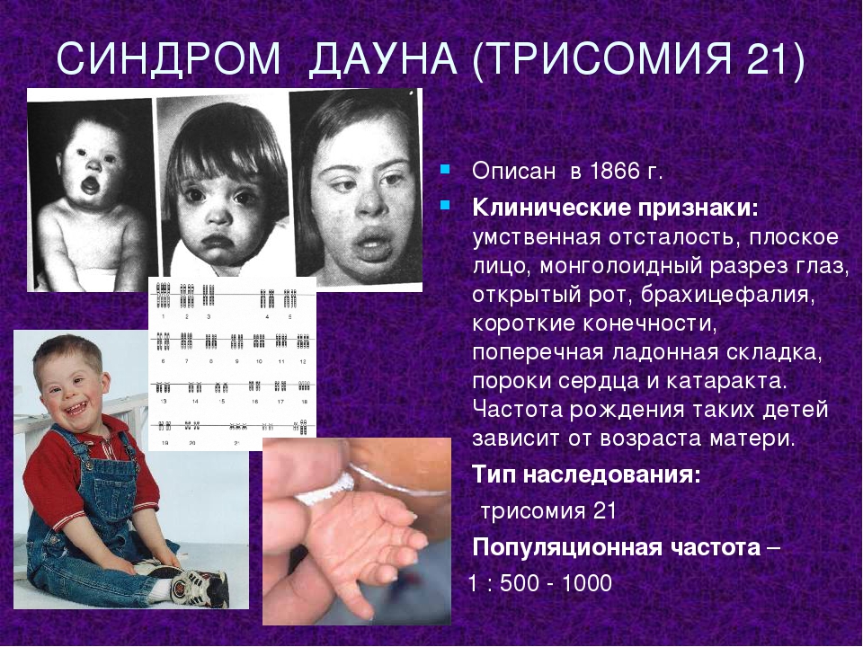 Синдром дауна: 3 обязательных признака и 8 сопутствующих проблем детей с трисомией по 21-й хромосоме
