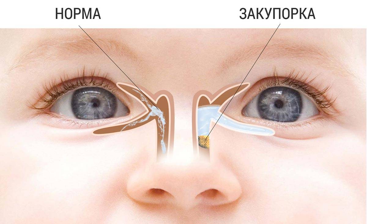 Конъюнктивит глаз у ребёнка