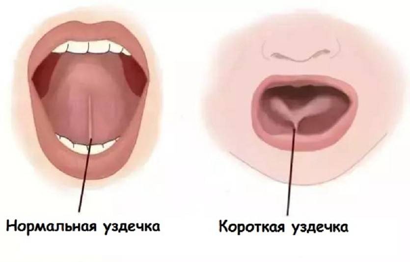 Короткая уздечка губы: признаки и исправление | colgate®