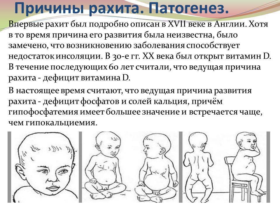 Рахит | симптомы | диагностика | лечение - docdoc.ru
