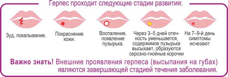 Герпес на губах —  витагерпавак