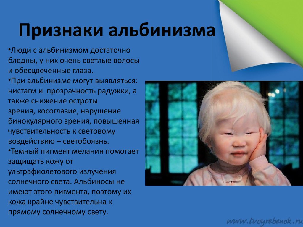 Альбинизм: фото, причины и лечение, диагностика