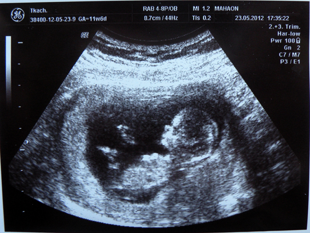 11 неделя беременности: что происходит с мамой и малышом | развитие плода и ощущения женщины на 11 неделе беременности