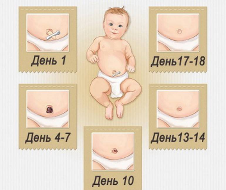 Пупочная грыжа у детей - лечение, симптомы, профилактика | детская хирургия см-клиники в санкт-петербурге