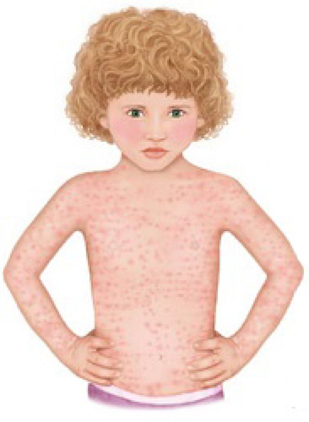Розеола у детей: причины, симптомы, методы диагностики, лечения и профилактики розеолы  