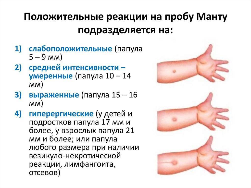 Какая норма манту у детей - детская городская поликлиника №1 г. магнитогорска
