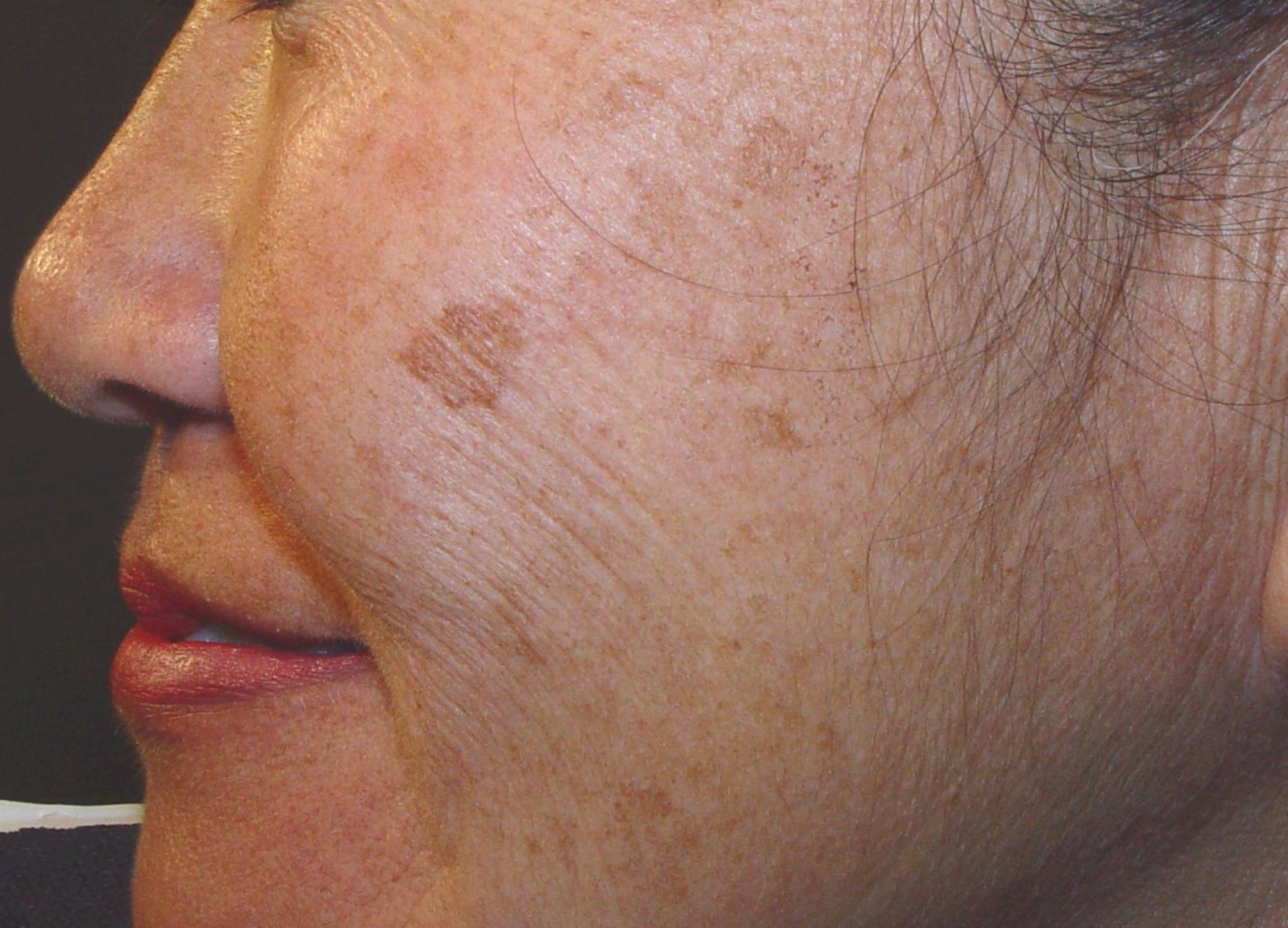 Гиперпигментация кожи - способы лечения