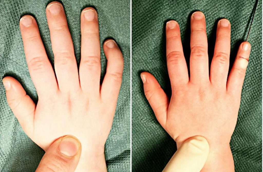 Что такое брахидактилия большого пальца и почему она возникает?