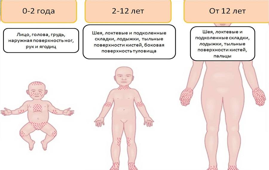Аллергический дерматит у грудного ребенка | 1дмц