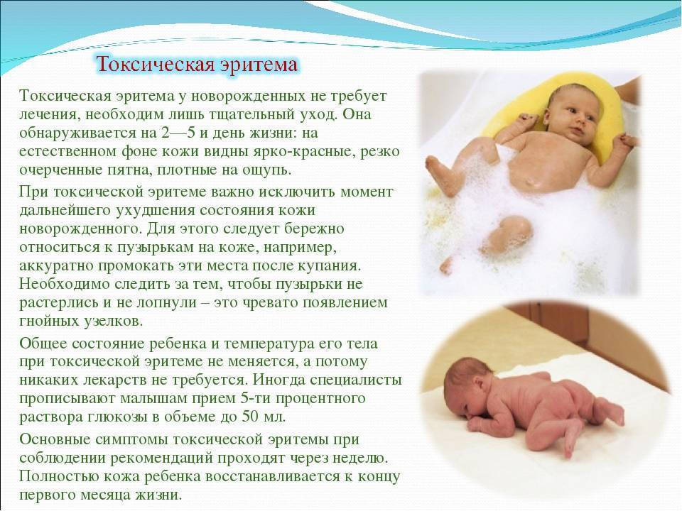Причины, лечение и последствия токсической и физиологической эритемы у новорожденных