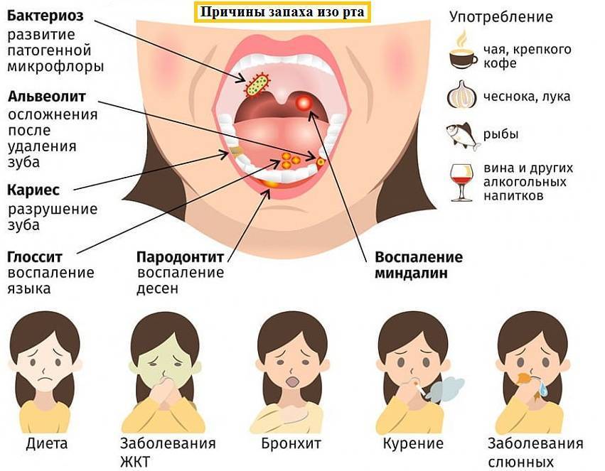 Запах изо рта: причины появления неприятного запаха изо рта и методы его лечения
