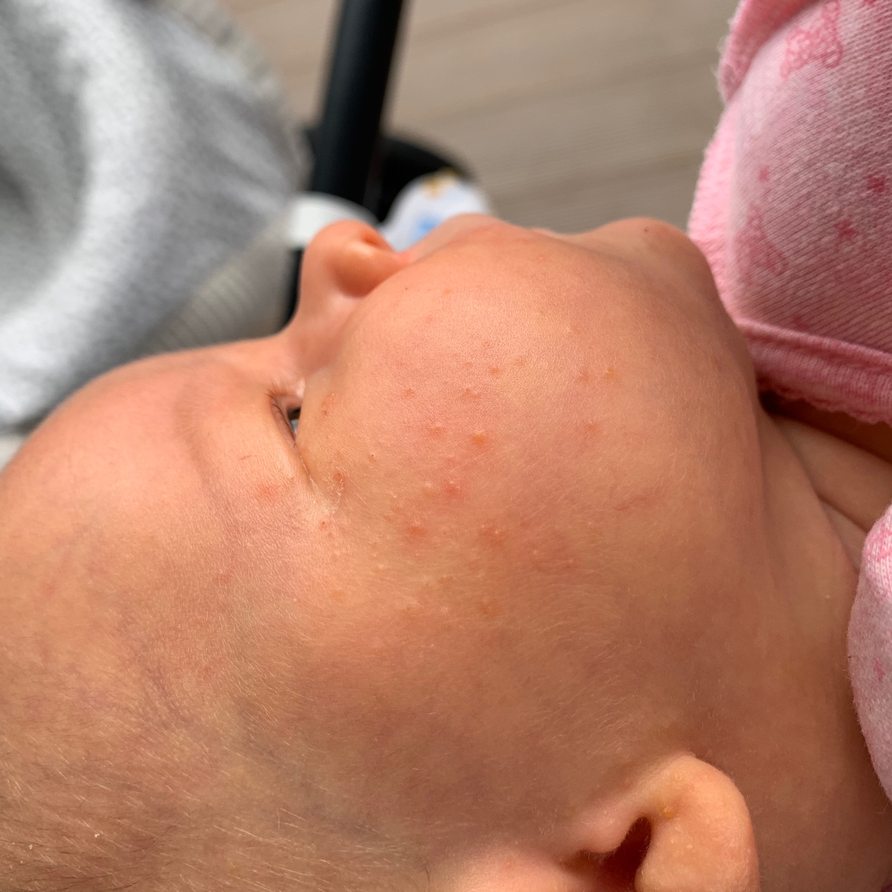 Причины, проявления и лечение аллергии у детей
