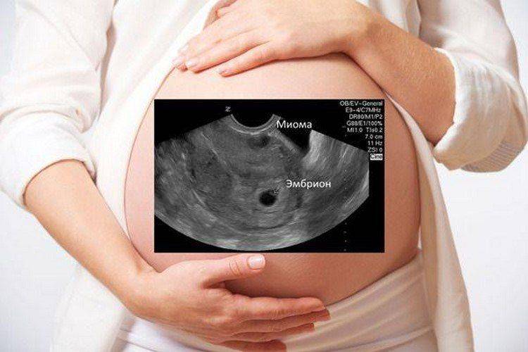 Миома матки и беременность. весомый повод обратиться к квалифицированному акушеру-гинекологу