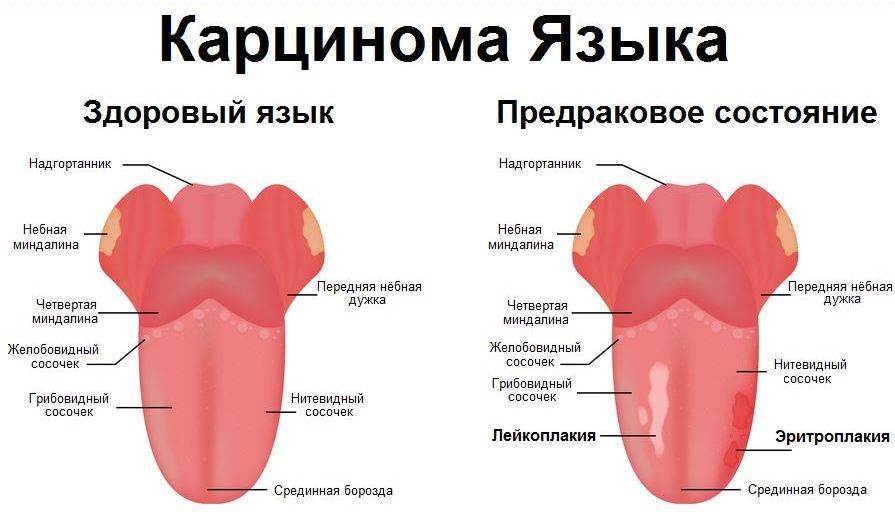 Причины белого налета на языке у ребенка
