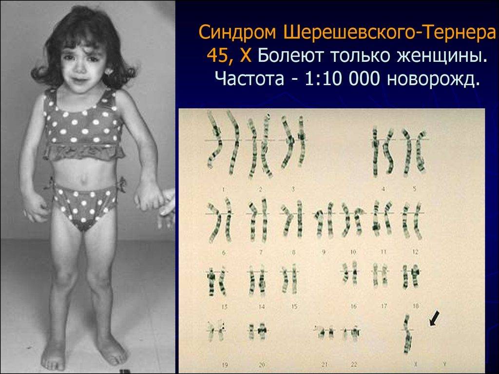 Синдром шерешевского тёрнера : 13 признаков генетического синдрома
