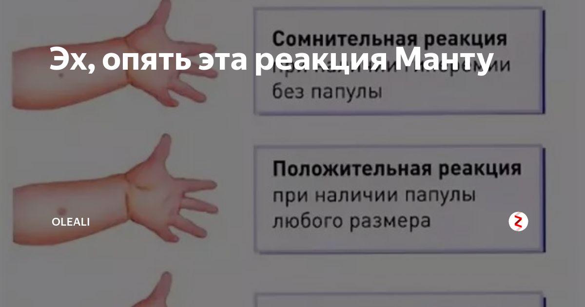 Манту в год норма какая. Гиперергическая папула диаскинтест. Реакция манту у ребенка 1 год нормы. Размер реакции манту у детей 1 года. Реакция манту у ребенка 3 года норма.