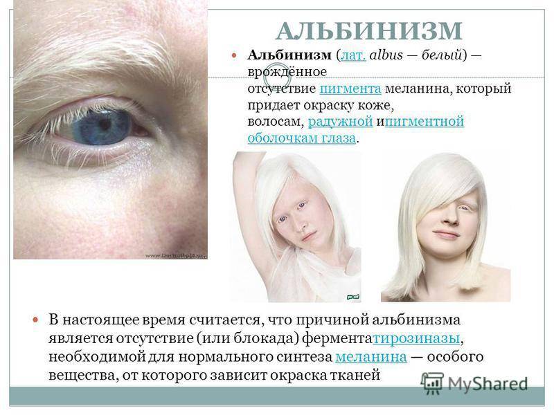 24 факта, которые вы не знали об альбинизме :: инфониак