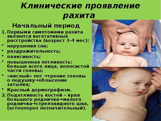 Профилактика рахита у детей до года и после. лечение рахита у новорожденных и грудничков.