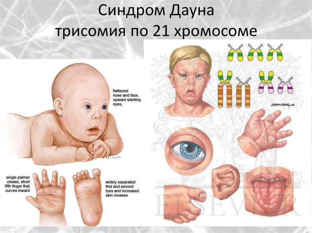 ✅ синдром патау: 7 признаков поражения органов и систем - ik-rt.ru