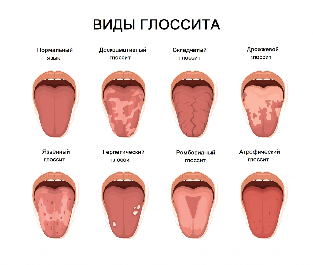 Язвы в полости рта - клинические признаки при различных заболеваниях | университетская клиника