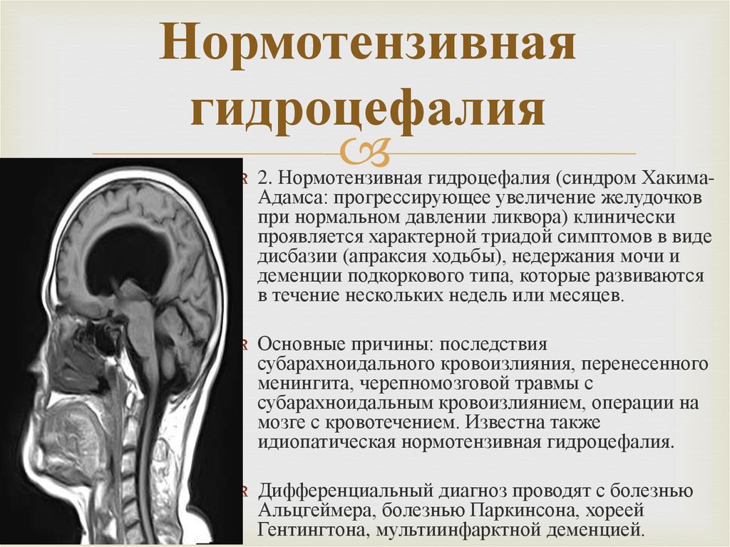 Гидроцефалия (водянка головного мозга) – что это такое, причины, признаки и симптомы гидроцефалии у взрослого и у ребёнка, диагностика и лечение