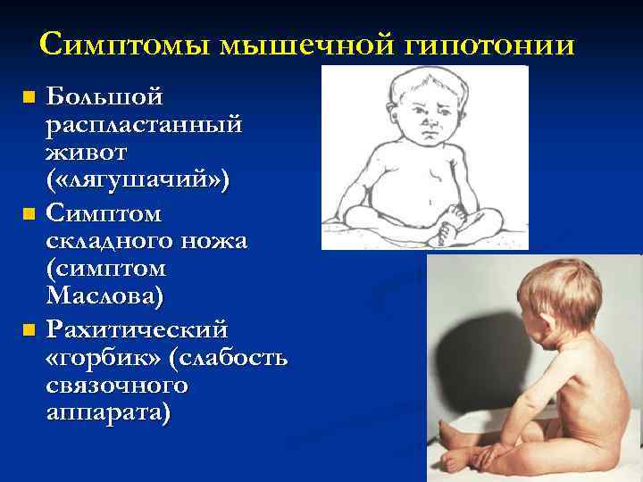 Гипертонус у ребенка | nutrilak