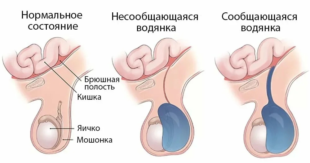 Водянка яичка (гидроцеле): причины, симптомы, диагностика и лечение — клиника «доктор рядом»