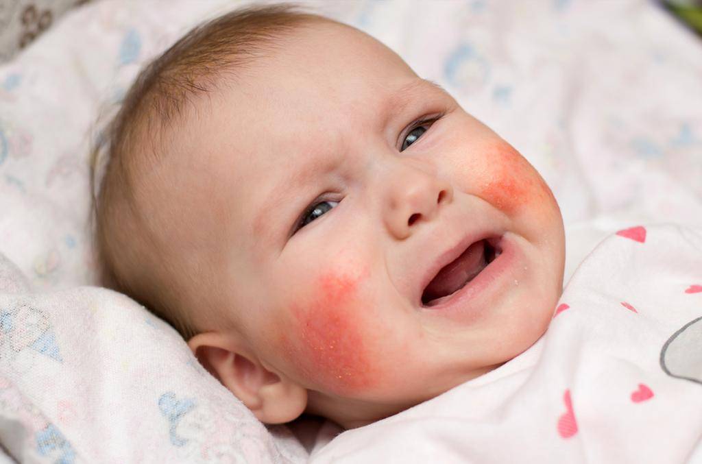 Аллергия на щеках у детей – причины, симптомы и лечение