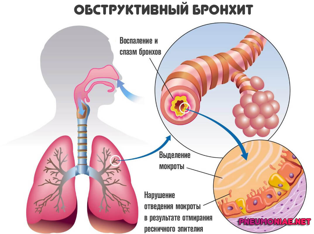 Бронхит у детей карта вызова