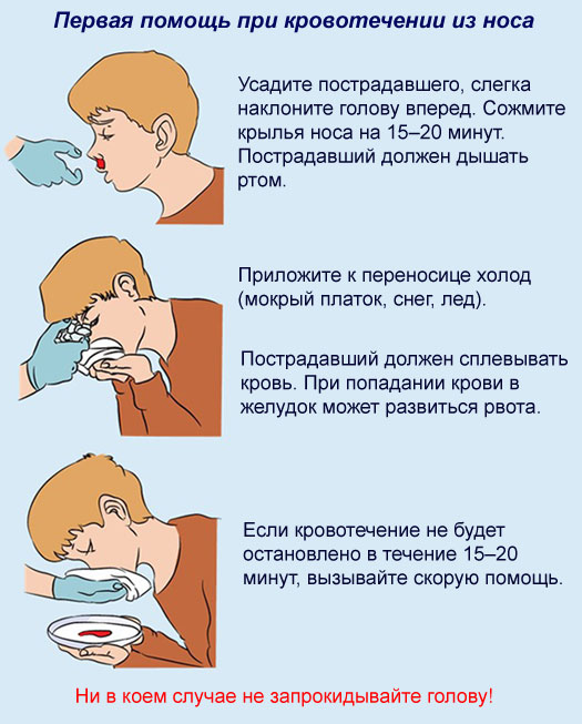 Кровь из носа у взрослого, у детей, при беременности, причины, симптомы, что делать? носовое кровотечение первая помощь.  :: polismed.com