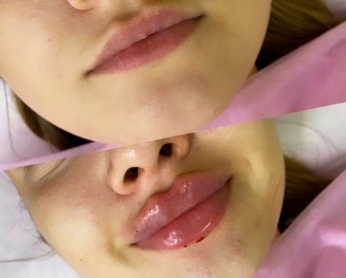 Как подготовиться к процедуре увеличения губ? | часто задаваемые вопросы об инъекционной косметологии