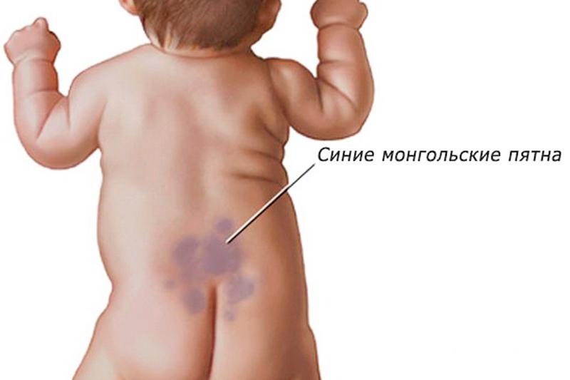 Причины монгольского пятна у новорожденного и что означает, методы лечения и диагностики