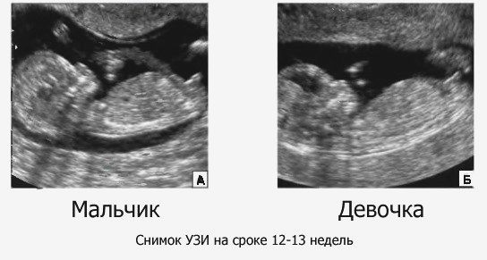 Беременность мальчиком и девочкой: отличия, фото / форма живота и пол будущего ребенка