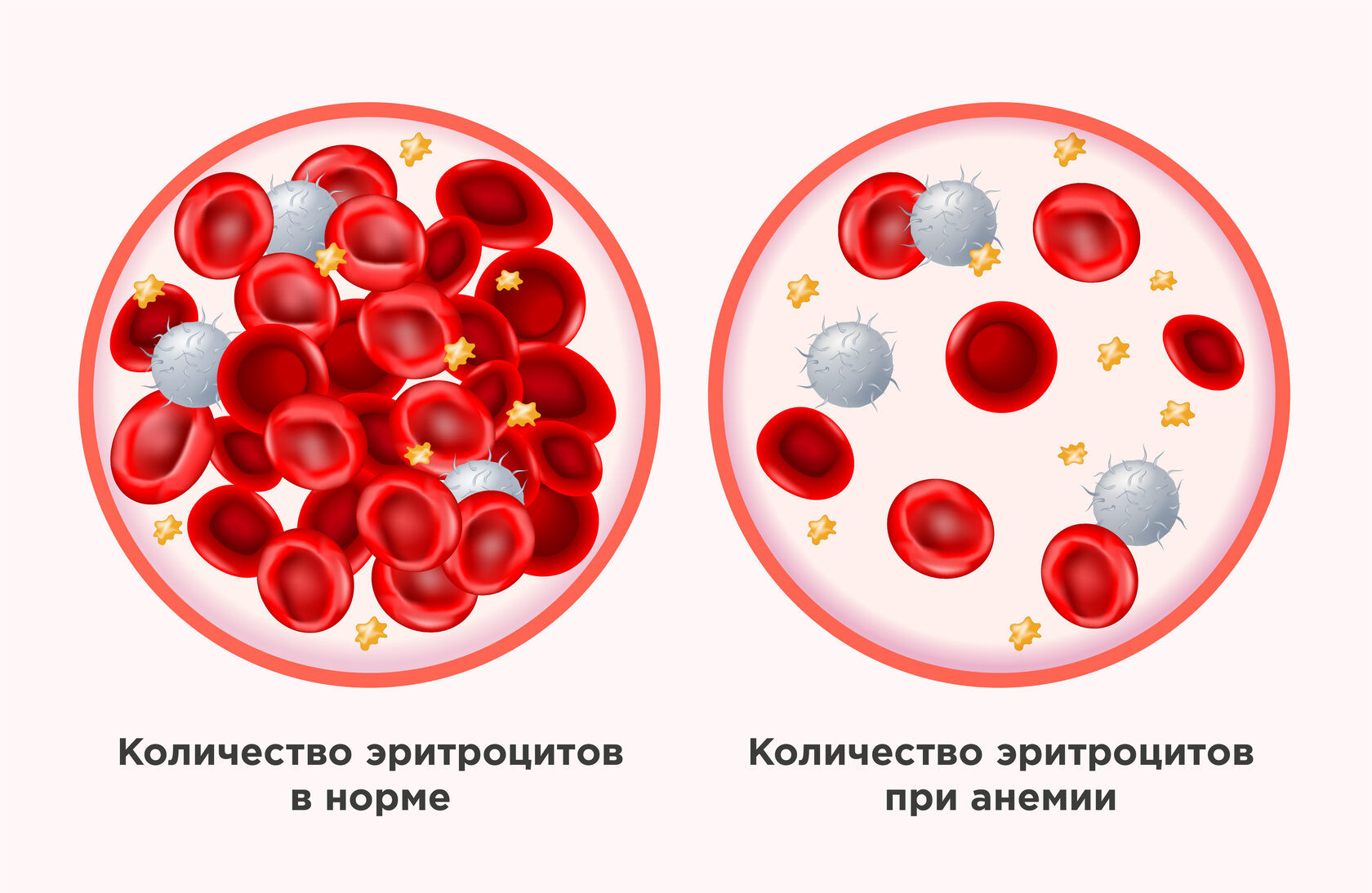 Анемия беременных