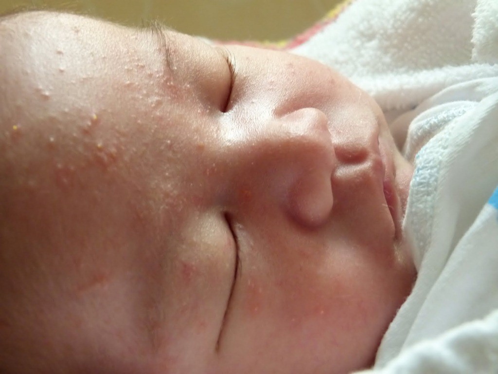 Акне новорожденных. как отличить акне от аллергии