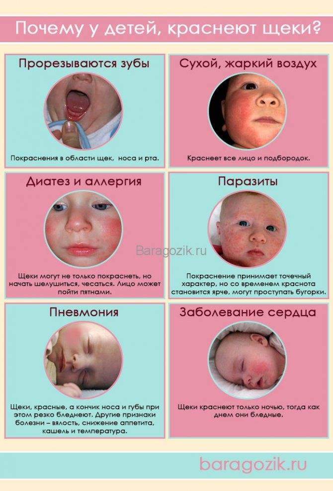Диатез на щеках у ребенка: лечение, советы комаровского
