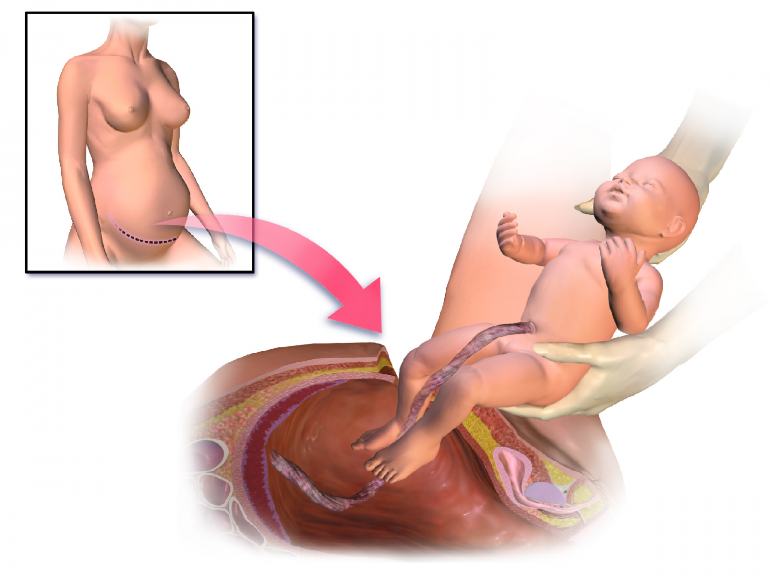 Рождение ребенка кесарево сечение. Родоразрешение кесарево сечение. Разрез после кесарева сечения.