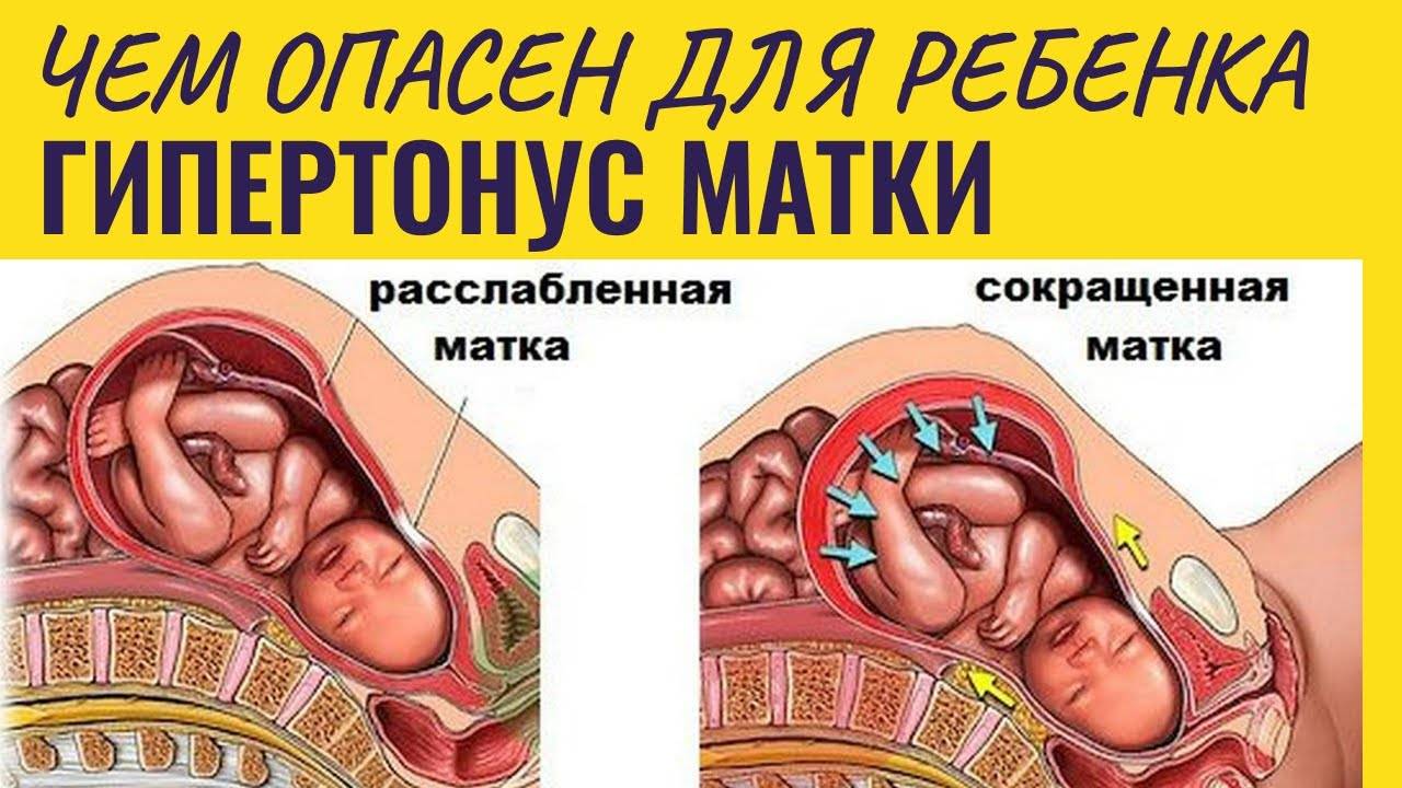 Гипертонус матки