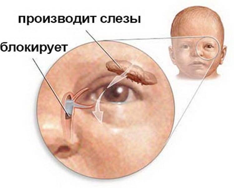 Почему гноится глаз у новорожденного ребенка, что делать, как лечить