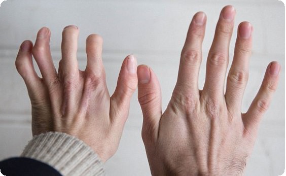 Брахидактилия, что такое брахидактилия большого пальца и как ее лечить?
