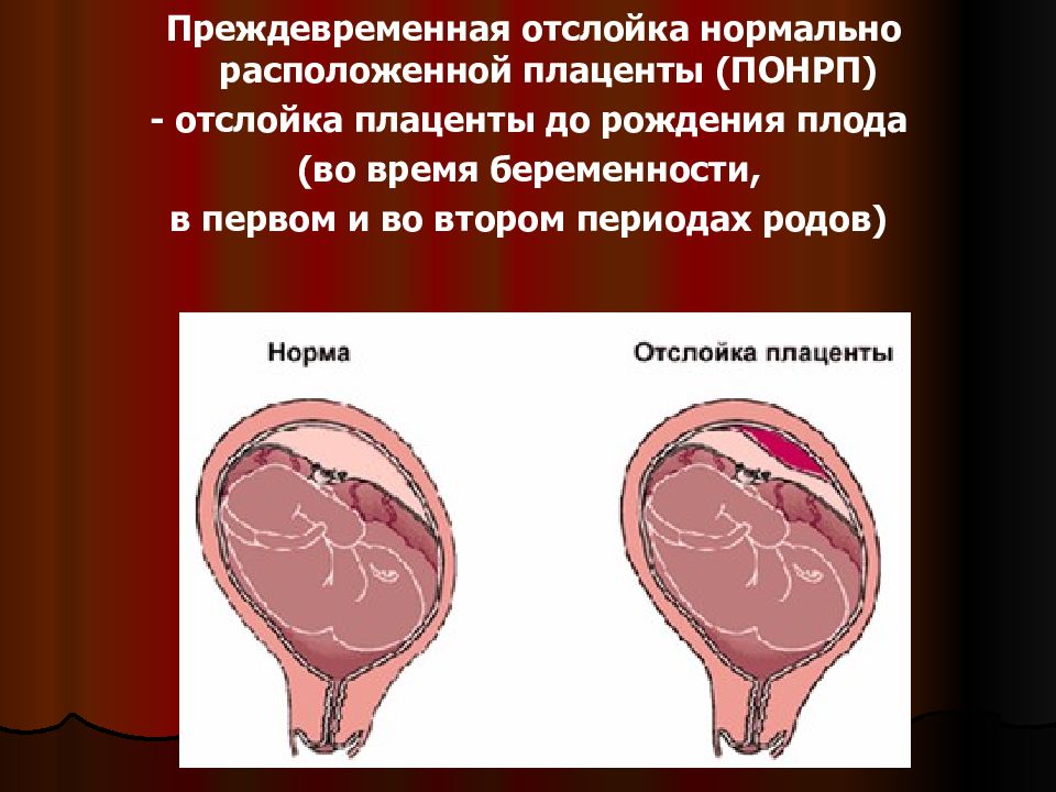 Преждевременная отслойка плаценты презентация