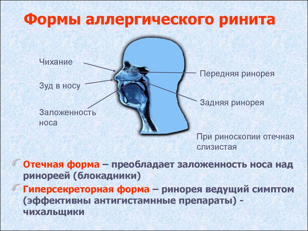 Ринит или насморк – какой бывает ринит? лечение в цэлт