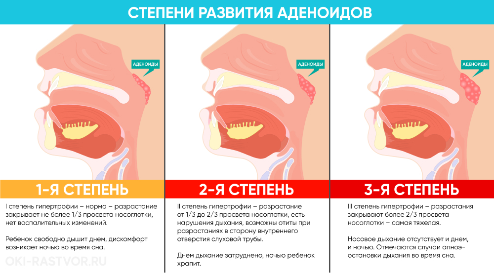 Схема лечения аденоидов у детей