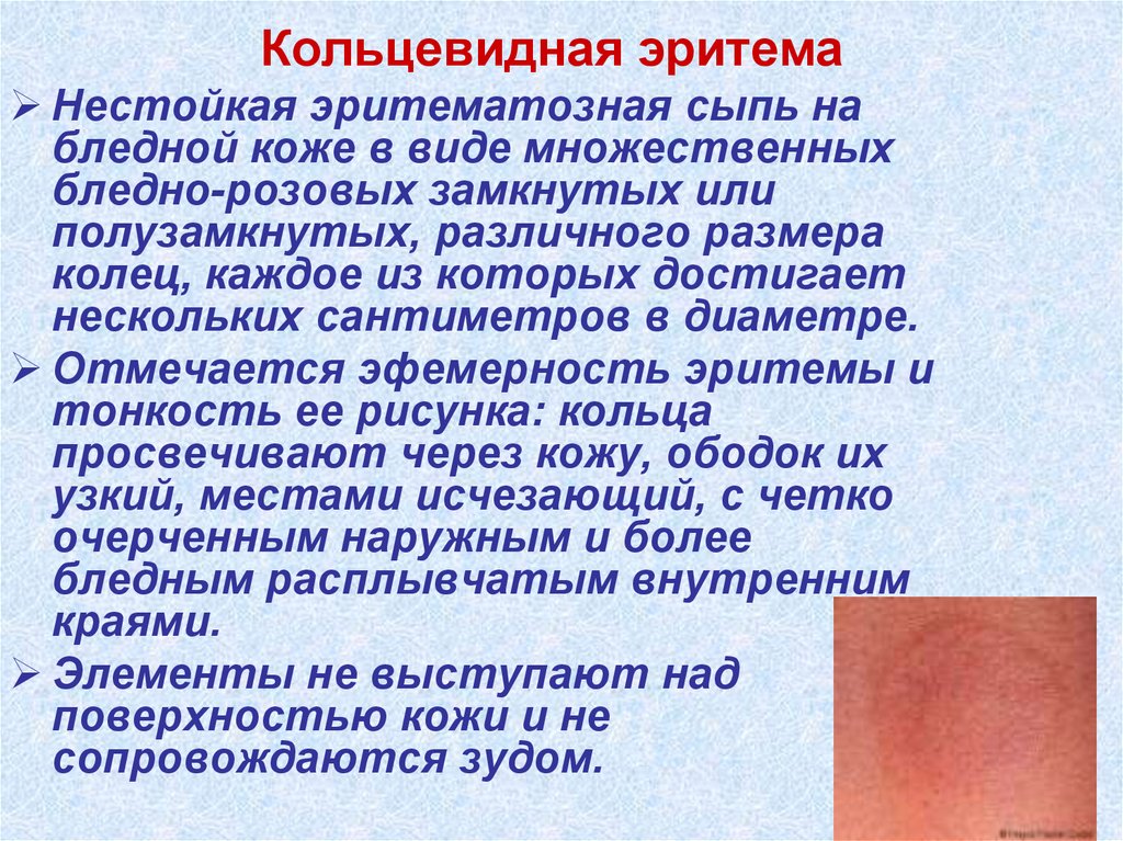 Токсическая эритема новорожденных: симптомы, причины и особенности лечения :: syl.ru