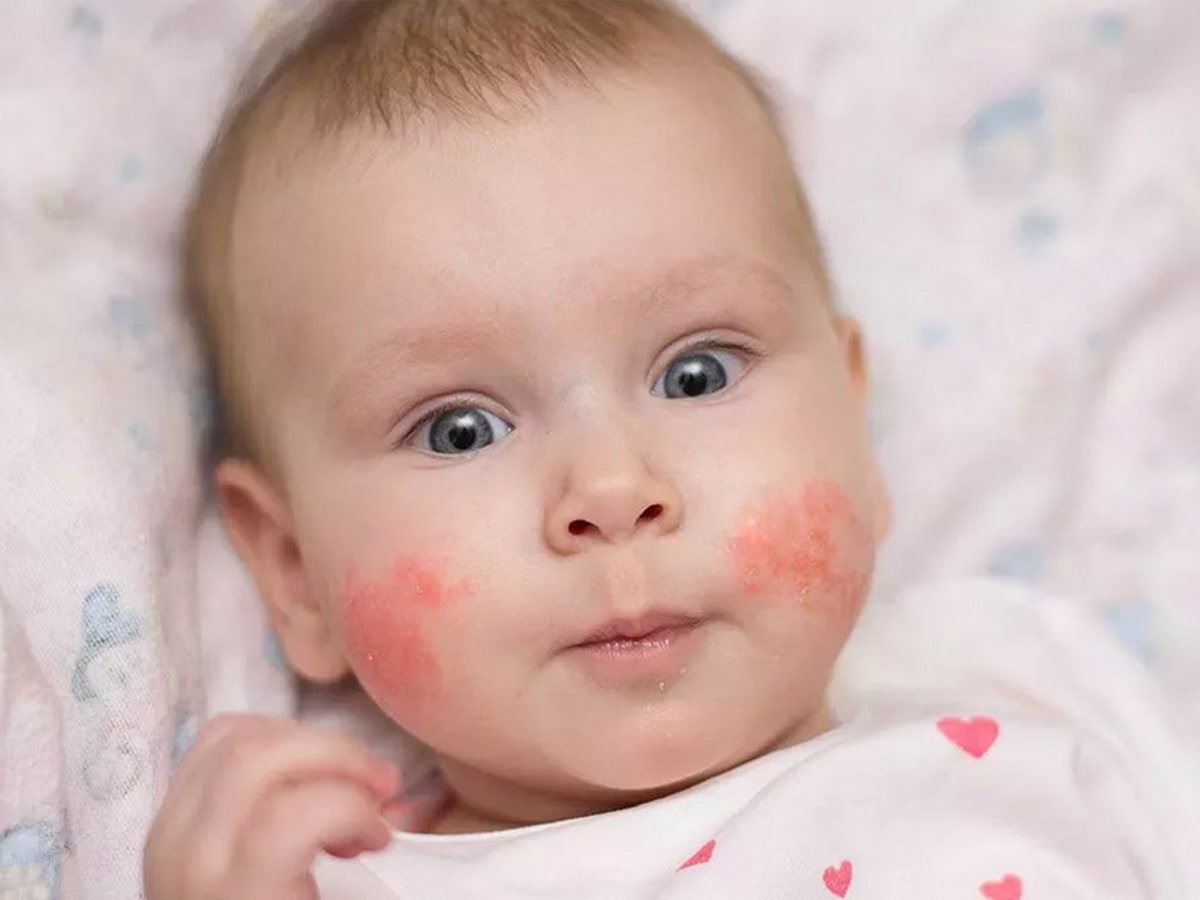 Как проявляется аллергия у ребенка — блог медицинского центра он клиник