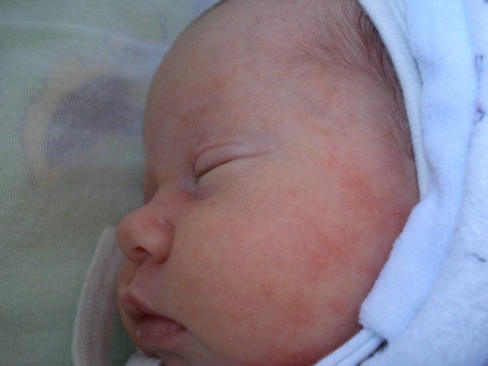 Сыпь у новорожденных и грудных детей (+фото)