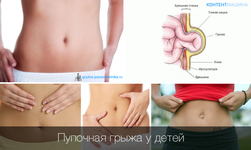 Операция при пупочной грыже у детей: показания, суть процедуры, отзывы
операция при пупочной грыже у детей: показания, суть процедуры, отзывы