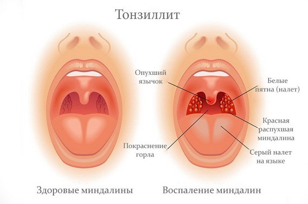 Схема лечения гнойной ангины