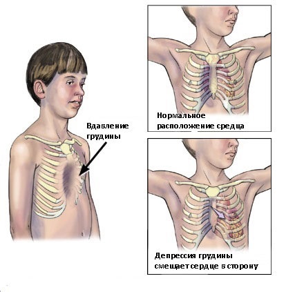 Фото, причины и лечение воронкообразной деформации грудной клетки у ребенка