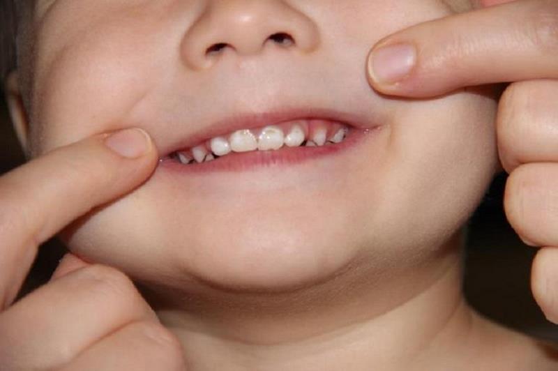 «ужасная статистика»: у некоторых в три года уже половина зубов удалена – детский стоматолог | медицинская россия